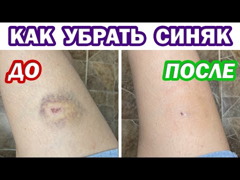 Лучшее средство ОТ СИНЯКОВ И ГЕМАТОМ! Как быстро убрать (избавиться) синяк в домашних условиях