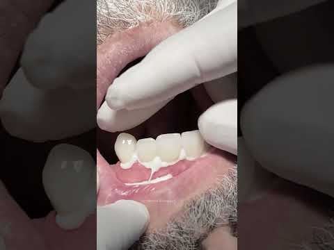 Zirconia crowns to