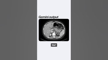 Gemini was able to scan a CT scan!
