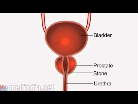 prostatic urethral calculus treatment