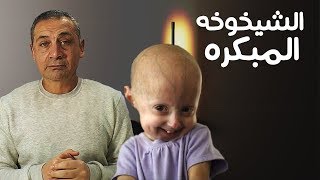 دردشة صحية | الشيخوخه المبكره بروجيريا Progeria