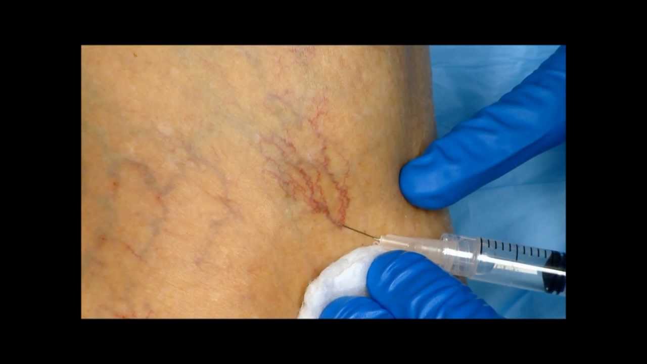 Cosmetic injection sclerotherapy for spider veins (telangiectasias