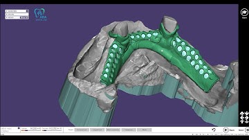 lower partial frame design with exocad basics case lingual bar    하악 파샬 디자인 영상