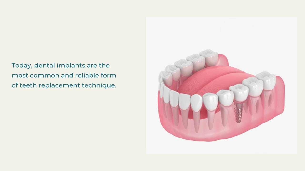 Are dental implants common Prabu Dental , Karaikudi YouTube