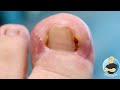 CUTTING OUT HER SUPER DEEP INGROWN TOENAILS FOREVER!!!