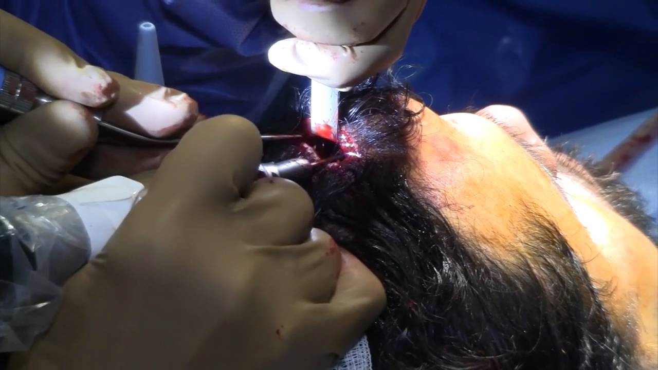 Osteoma by Dr. Philip Miller
