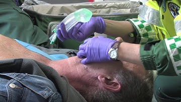 Igel Insertion