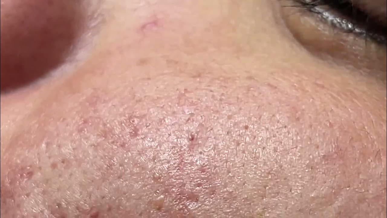 how-to-remove-whiteheads-from-face-mai-ng-c-s-family-youtube