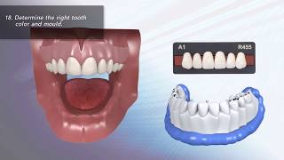 AvaDent Overdenture On Bar With 2 Implants