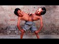 UNUSUAL Conjoined Twins You Won't Believe Exist