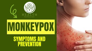 Monkeypox Or Mpox Symptoms And Prevention