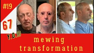 Mewing Transformation After 40