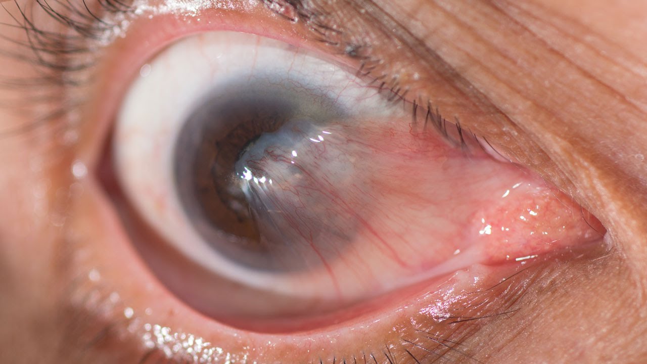 Human Physiology Visual Impairments Cataracts YouTube