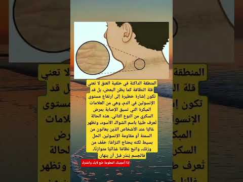المنطقة الداكنة في خلفية العنق لا تعني قلة النظافة بل قد تكون إشارة إلى ارتفاع مستوى الإنسولين