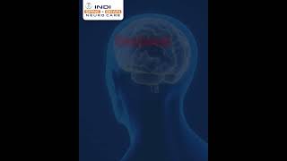 🧠 𝗘𝘅𝗰𝗶𝘀𝗶𝗼𝗻 𝗼𝗳 𝗕𝗿𝗮𝗶𝗻 𝗧𝘂𝗺𝗼𝗿𝘀