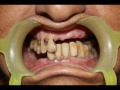 Fixed teeth using implant in 72 hrs  senthil dental care