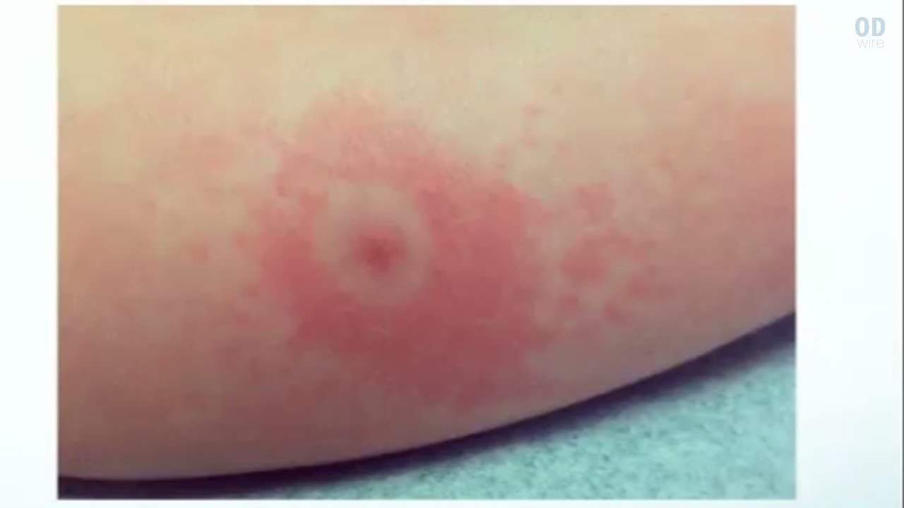 The Consequences of Lyme Disease on Vision YouTube