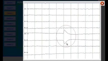 EEG artifacts