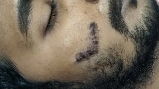 Srijan Plastic Surgery is live - Stitch removal after scar revision surgery on day 7