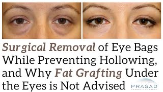 How Eye Bags are Removed without Causing Hollowing or Scarring, and Why Fat Transfer is Not Advised