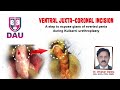 Ventral juxta coronal incision during kulkarni urethroplasty urethroplasty dr divakar dalela