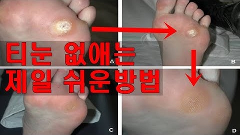 티눈 제거하는 방법