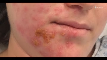 What is Ramsay Hunt Syndrome?