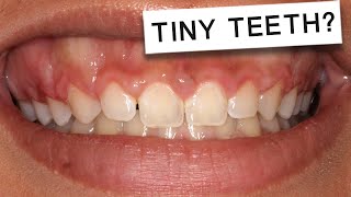 How To Get Rid Of A GUMMY SMILE Make Your TEETH Look LONGER!