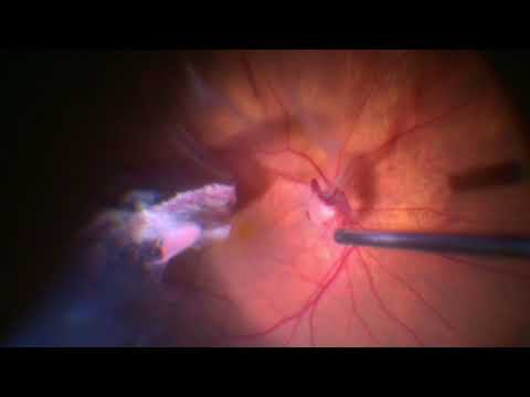 Video: Hemorrhage In The Eye - Vitreous Hemorrhage, Symptoms And Treatment