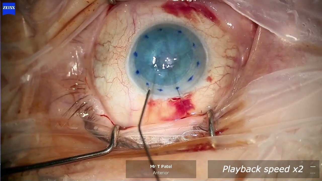 DMEK - technique managing a folded and upside down graft. (pre and post op appearance of eye at end)