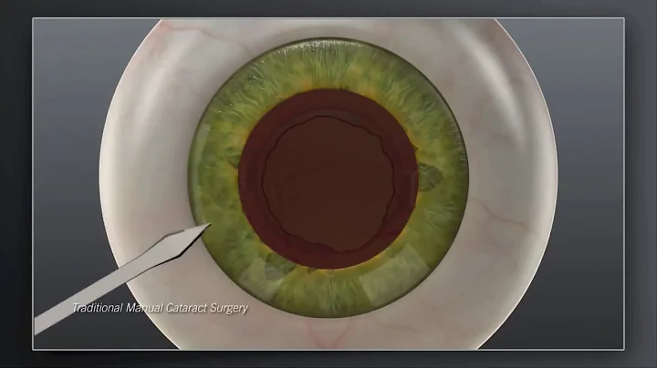 Catalys Laser Cataract Surgery  vs Traditional Manual Animation | Cataract Treatment | #cataracts
