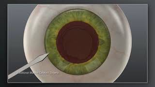 Catalys Laser Cataract Surgery  vs Traditional Manual Cataract Surgery  Animation