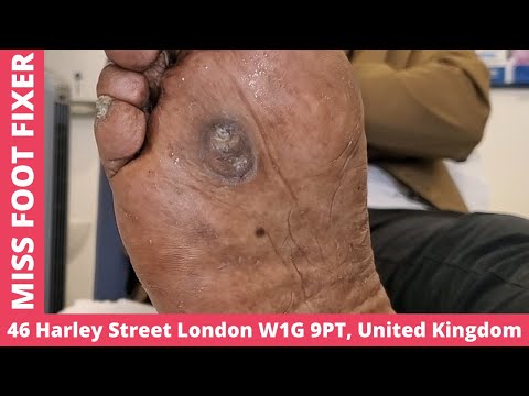 Video: Pedicure product - Keratolytic for feet - Removal of corns, cracks, corns, rough skin, SKINTERRIA Video: Pedicure product - Keratolytic for feet - Removal of corns, cracks, corns, rough skin, SKINTERRIA