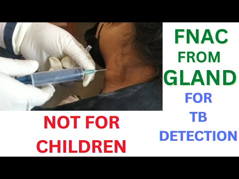Gland's Sample Collection Procedure । FNAC Of Cervical Lymph Nodes