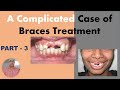 A Complicated Case of Braces Treatment - Part 3