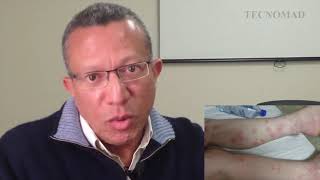 PERCEVEJOS DE CAMA