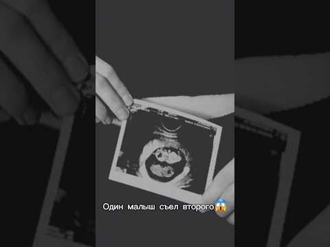 Была беременна двойней. Фето-фетальный синдром. А потом на НИПТ высокий риск синдрома Дауна.