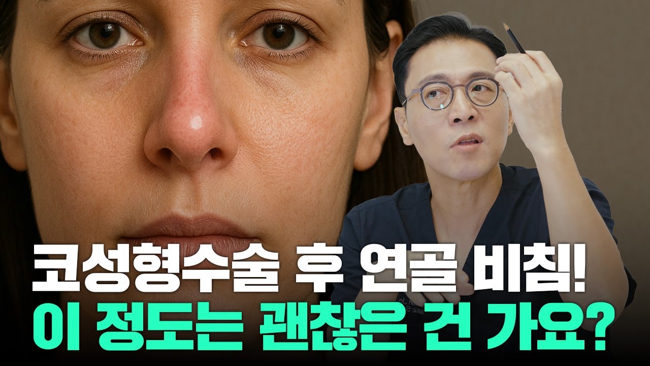 330화. 코수술 후 연골이 비쳐요ㅠㅠ 이 정도는 괜찮은건가요? (feat. 교정방법)