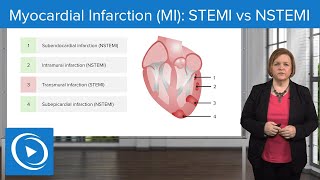 Myocardial Infarction (MI): STEMI vs NSTEMI – Med-Surg Nursing | Lecturio Nursing