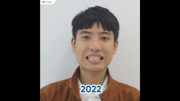 Thầy Giáo Trẻ Sở Hữu Gương Mặt Điển Trai Sau 15 Tháng Niềng Răng X-Matrix!