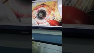 جراحة المياه البيضاء chirurgie de cataracte