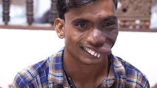 Hemangioma Face Tumor for this Man from India