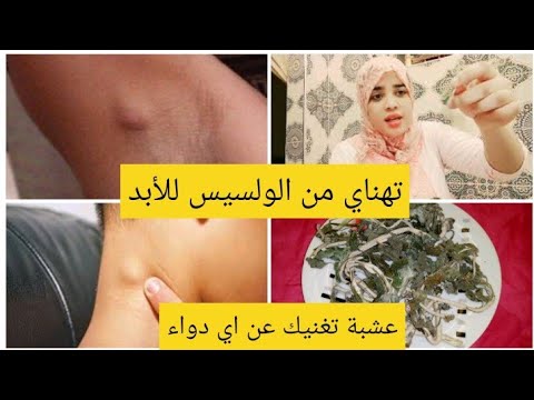 علاج الولسيس فاي ماكان ف الجسم بهاد العشبة