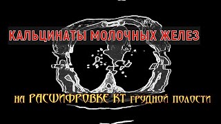 Мелкие КАЛЬЦИНАТЫ В МОЛОЧНОЙ ЖЕЛЕЗЕ на расшифровке КТ органов грудной клетки