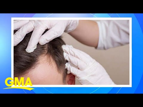 New study finds some natural hair loss remedies may work | GMA