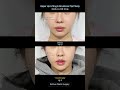 ✅Upper lip lift &amp; Revisional Tip Plasty(인중축소수술&amp;코끝 재수술)