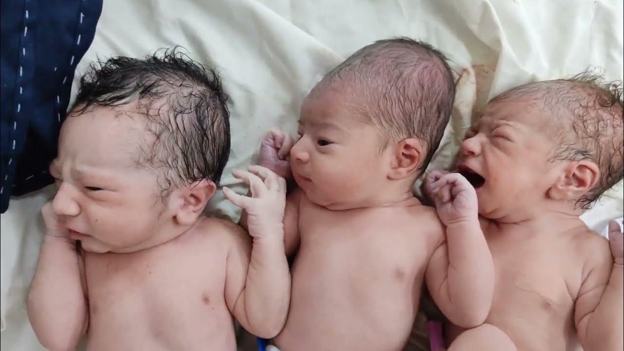 Triplets newborn Babies just after normal birth with Cone Heads ️ ️