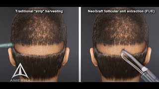 NeoGraft hair transplant procedure - animation screenshot 1