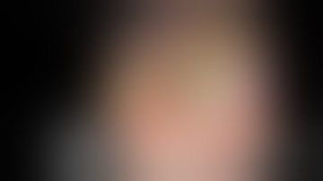 Spyglass Holmium Laser of Large CBD Stone in ERCP