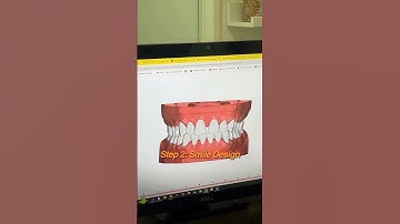 Invisalign explain under 20 secs #invisalign #aligners #smilemakeover